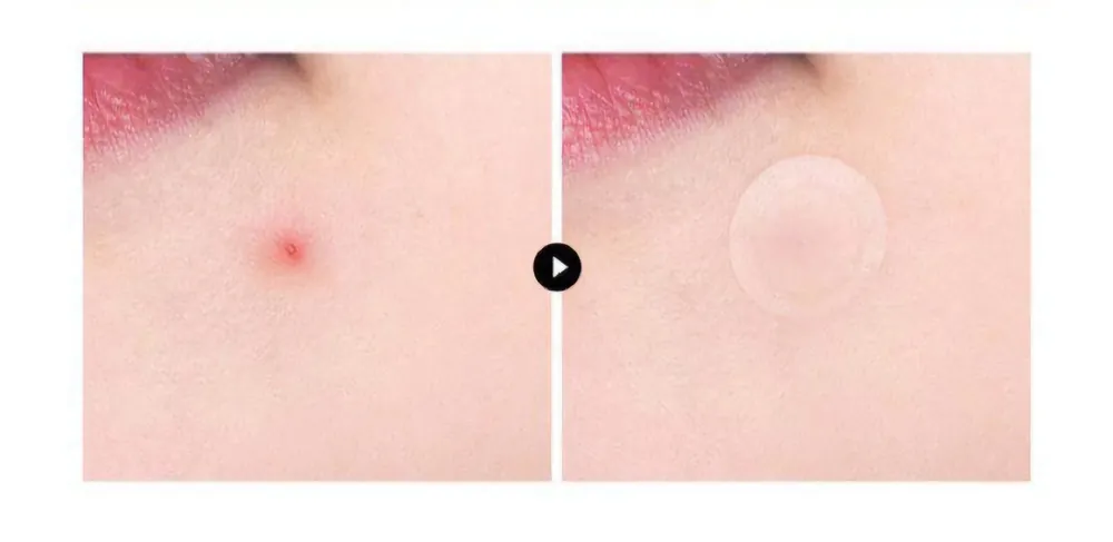 VT COSMETICS Náplasti na akné Pro Cica Centella Asiatica Tiger Clear Spot Patch (66 ks) Nakupujte Hned